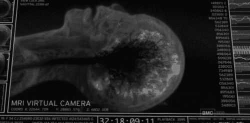 Dying while having an MRI scan (from The Walking Dead)